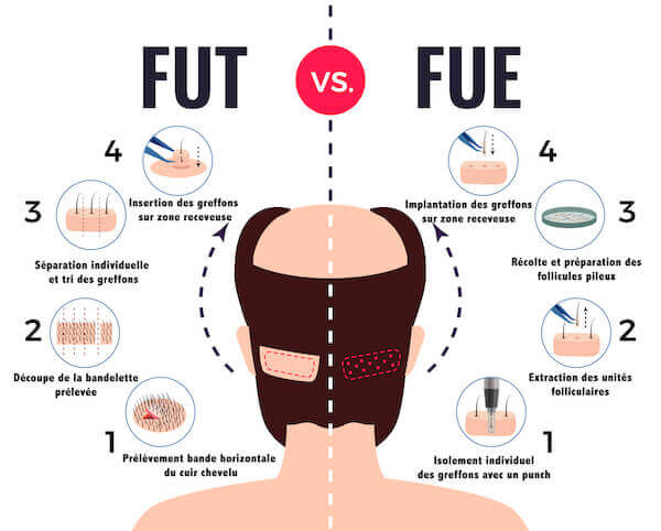 technique FUE et FUT 